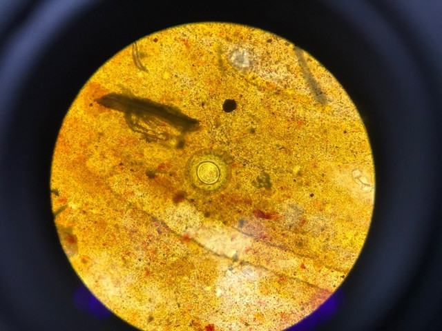 Hình ảnh trứng sán dây nhỏ Hymenolepiasis của bệnh nhân đến khám