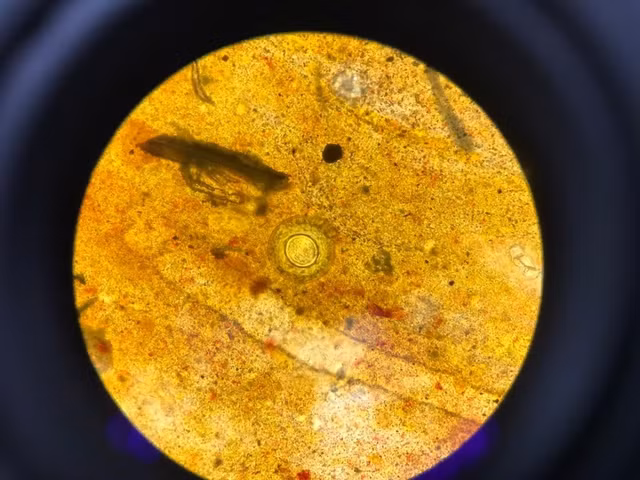 Hình ảnh trứng sán dây nhỏ Hymenolepiasis của bệnh nhân đến khám