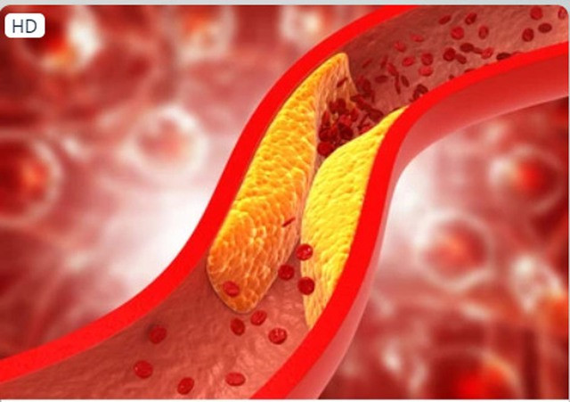 Uống trà sả giúp giảm cholesterol. Ảnh: Shutterstock Uống trà sả giúp giảm cholesterol. Ảnh: Shutterstock