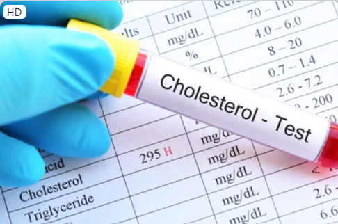 Người bị cholesterol cao có nguy cơ cao bị bệnh tim và đột quỵ. Ảnh: Shutterstock Người bị cholesterol cao có nguy cơ cao bị bệnh tim và đột quỵ. Ảnh: Shutterstock