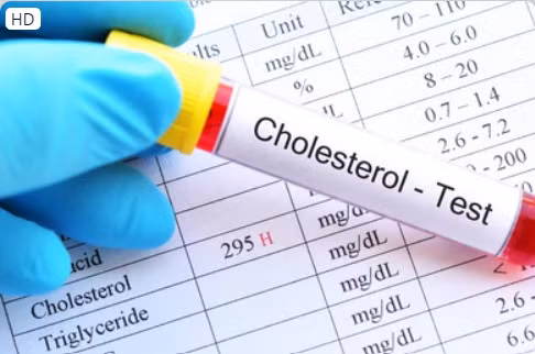 Người bị cholesterol cao có nguy cơ cao bị bệnh tim và đột quỵ. Ảnh: Shutterstock