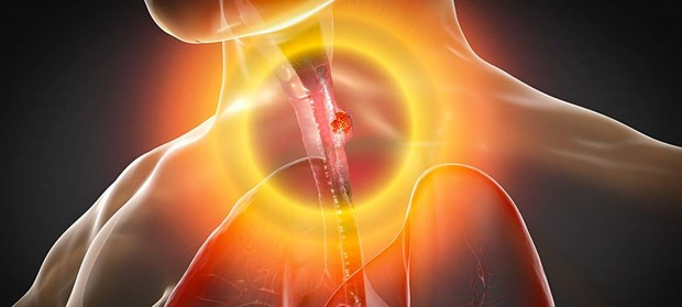 Trong một số phương pháp điều trị và đặc biệt là trong trường hợp hóa trị, bệnh nhân ung thư thực quản có thể mất vị giác hoặc vị giác bị thay đổi. Nguồn: Getty Images Trong một số phương pháp điều trị và đặc biệt là trong trường hợp hóa trị, bệnh nhân ung thư thực quản có thể mất vị giác hoặc vị giác bị thay đổi. Nguồn: Getty Images