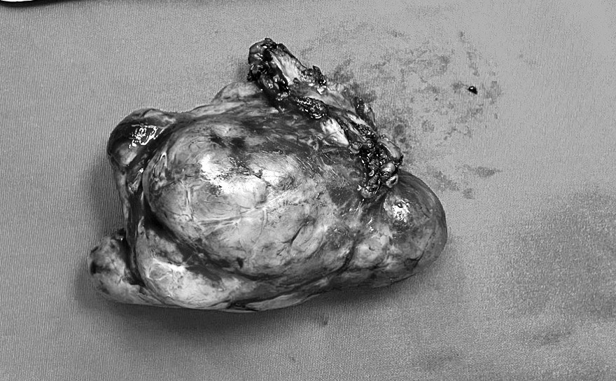 Khối u &quot;khủng&quot; vừa được các Bác sĩ phẫu thuật, lấy ra khỏi người bệnh nhân. Ảnh: Hồng Chuyên