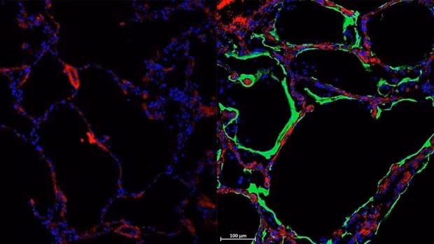 Hình ảnh LRRC15 (màu xanh) xuất hiện trên phổi của người đã qua đời vì COVID-19. Nguồn: sydney.edu.au