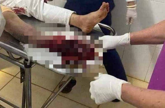 Anh H. bị thương gãy nát bàn chân phải. Ảnh: Người dân cung cấp