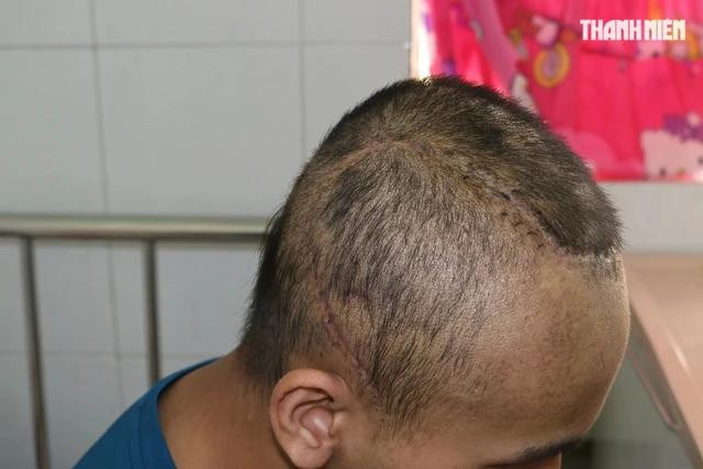Vết sẹo hình thành trên đầu em Giàu sau cuộc đại phẫu cắt bỏ khối ung thư Vết sẹo hình thành trên đầu em Giàu sau cuộc đại phẫu cắt bỏ khối ung thư