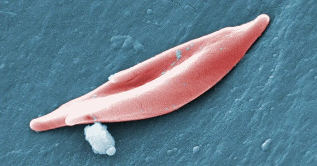 Anh phê duyệt thuốc chỉnh sửa gien đầu tiên trên thế giới - Ảnh 1. Một hồng cầu hình liềm