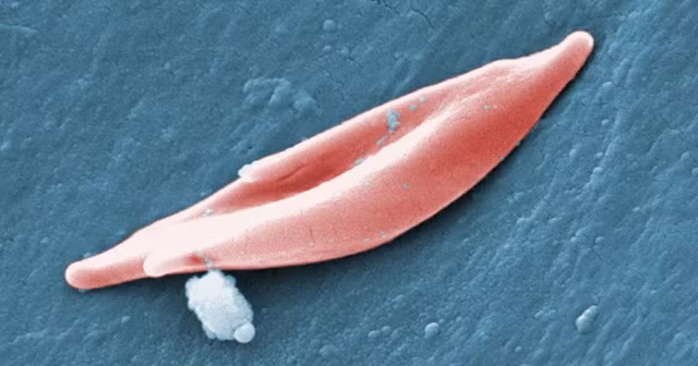 Một hồng cầu hình liềm