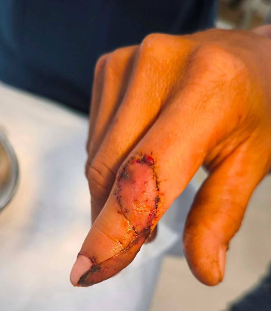 Một ca bệnh sau khi được sử dụng kỹ thuật đắp, ghép phần thịt và da. Ảnh: V.H