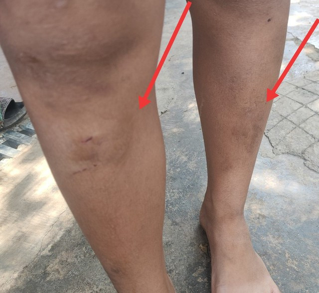 Một trong 5 cháu nhỏ bị 2 mẹ con bà T. đánh Một trong 5 cháu nhỏ bị 2 mẹ con bà T. đánh