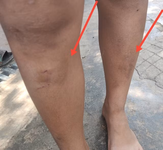 Một trong 5 cháu nhỏ bị 2 mẹ con bà T. đánh