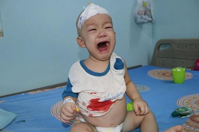 Phát được lấy ven ở trên đầu vì ven ở tay, chân đã xơ cứng Phát được lấy ven ở trên đầu vì ven ở tay, chân đã xơ cứng