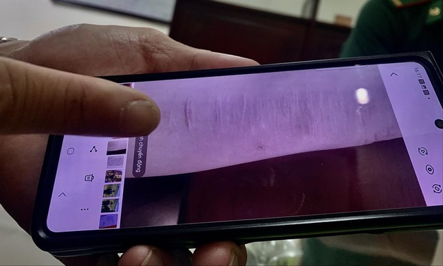 Trong ảnh là những vết sẹo do mỗi khi bị ngược đãi, cô gái dùng dao lam rạch lên tay Trong ảnh là những vết sẹo do mỗi khi bị ngược đãi, cô gái dùng dao lam rạch lên tay