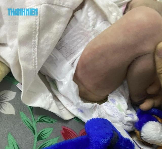 Sau trận bạo hành, đùi em bé (1 tháng tuổi) xưng đỏ, in rõ dấu bàn tay Sau trận bạo hành, đùi em bé (1 tháng tuổi) xưng đỏ, in rõ dấu bàn tay