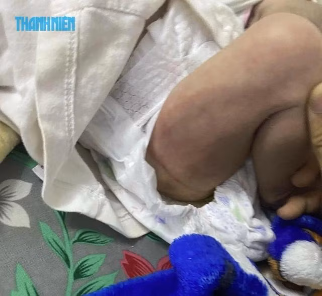 Sau trận bạo hành, đùi em bé (1 tháng tuổi) xưng đỏ, in rõ dấu bàn tay