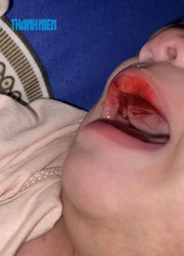 Sau cú tát, miệng bé Nghĩa chảy nhiều máu, em đau đớn khóc nấc Sau cú tát, miệng bé Nghĩa chảy nhiều máu, em đau đớn khóc nấc