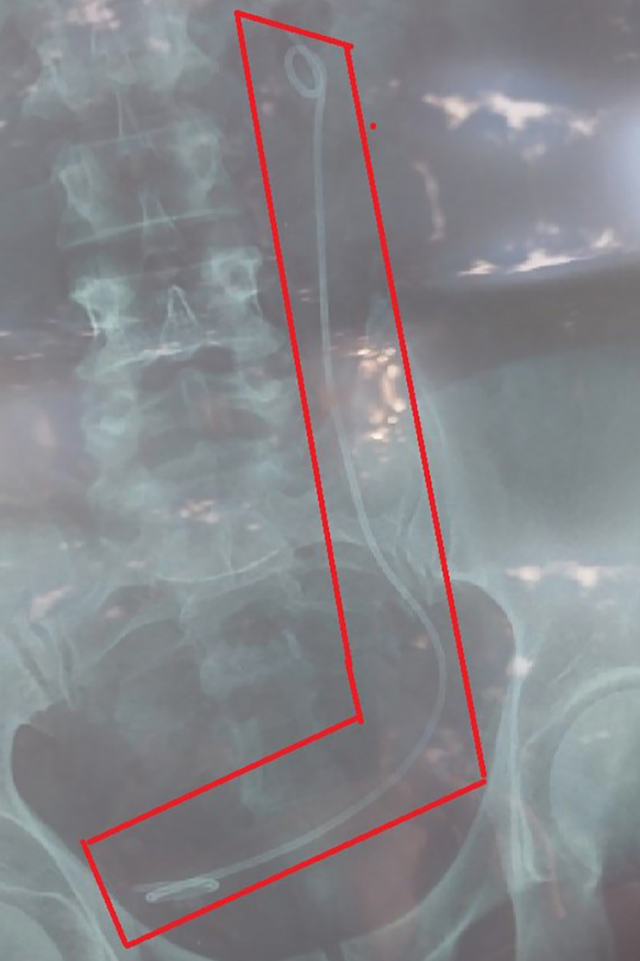 Kết quả X-quang dị vật của bệnh nhân cần mổ bị bác sĩ nhầm với bệnh nhân khác dẫn đến phẫu thuật sai người. Ảnh: VNE