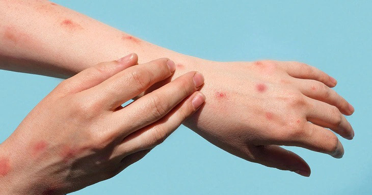 Đậu mùa khỉ lây lan nhanh chóng khiến giới y tế lo ngại. Ảnh: Shutterstock Đậu mùa khỉ lây lan nhanh chóng khiến giới y tế lo ngại. Ảnh: Shutterstock