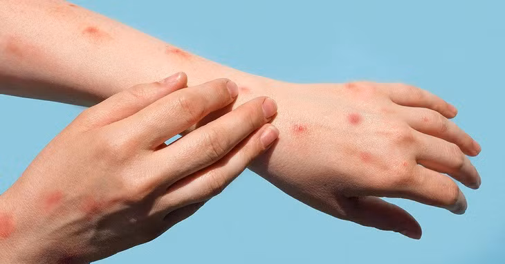 Đậu mùa khỉ lây lan nhanh chóng khiến giới y tế lo ngại. Ảnh: Shutterstock