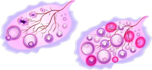 Phụ nữ mắc PCOS thường bị rối loạn tổng hợp nội tiết tố gonadotropin dẫn đến các vấn đề về rụng trứng
