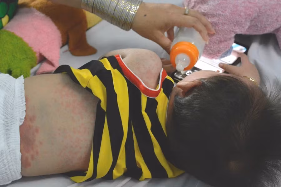 Trẻ mắc sởi đang điều trị tại Bệnh viện Nhi đồng 1