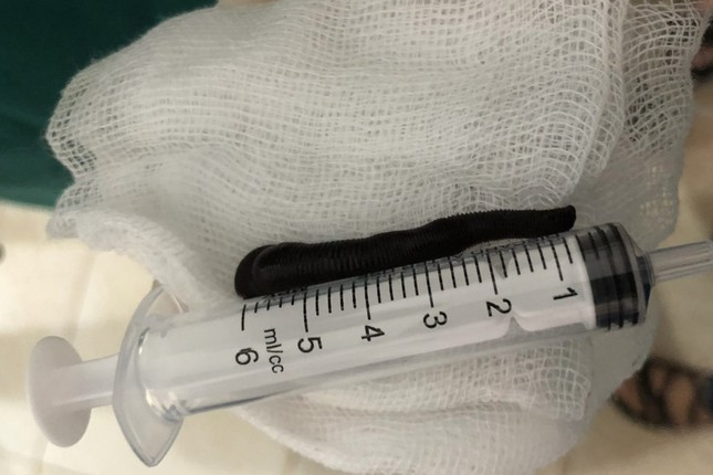 Con đỉa được gắp ra khỏi khí quản bệnh nhân T. dài hơn 6 cm