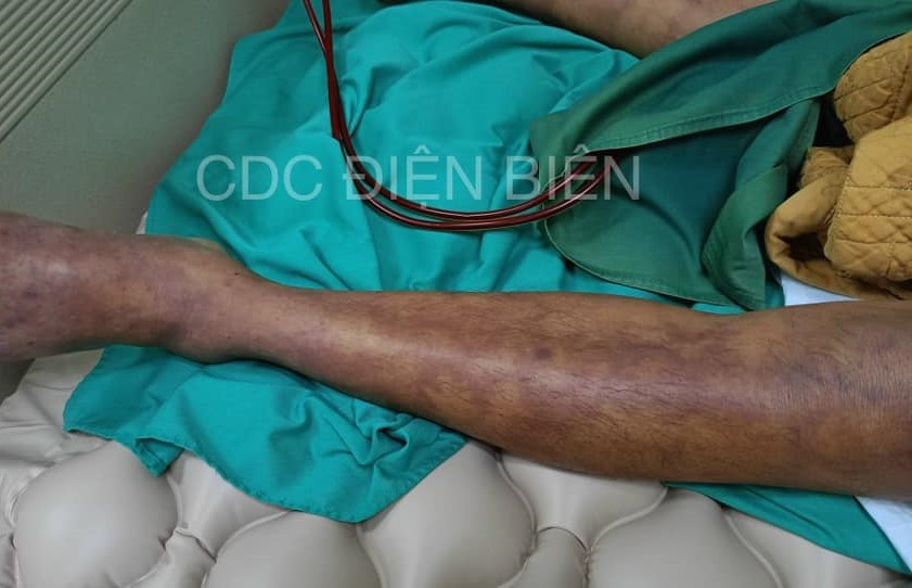 Sau khi ăn tiết canh heo, người đàn ông bị nhiễm liên cầu lợn, chân tay tím tái. Ảnh: CDC Điện Biên