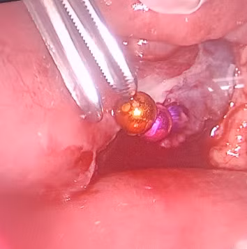 Bác sĩ đã mổ nội soi gắp 10 viên nam châm ra ngoài cho bé. Ảnh: bệnh viện cung cấp