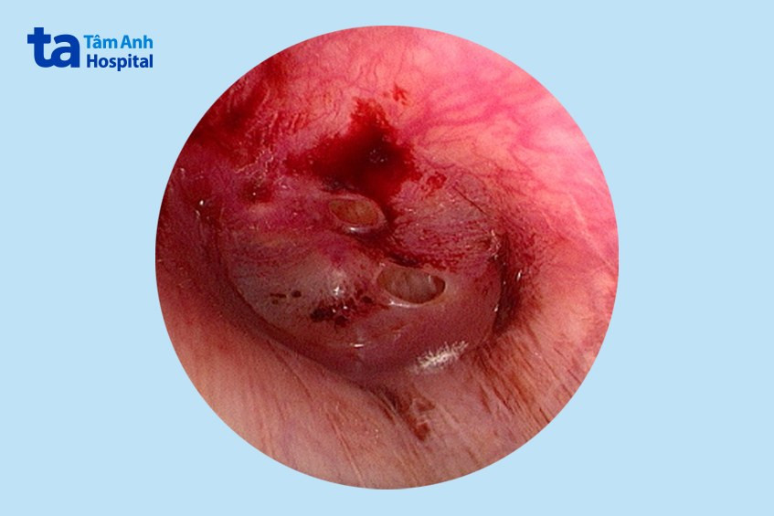 Hình ảnh nội soi 2 vết thủng và 1 vết sẹo đọng máu ở màng nhĩ người bệnh