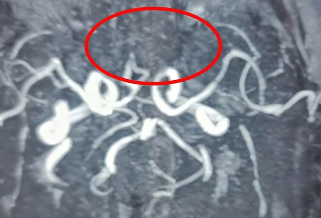 Hình ảnh MRI ghi nhận vị trí bị tắc mạch máu não ở người bệnh thời điểm nhập viện Hình ảnh MRI ghi nhận vị trí bị tắc mạch máu não ở người bệnh thời điểm nhập viện