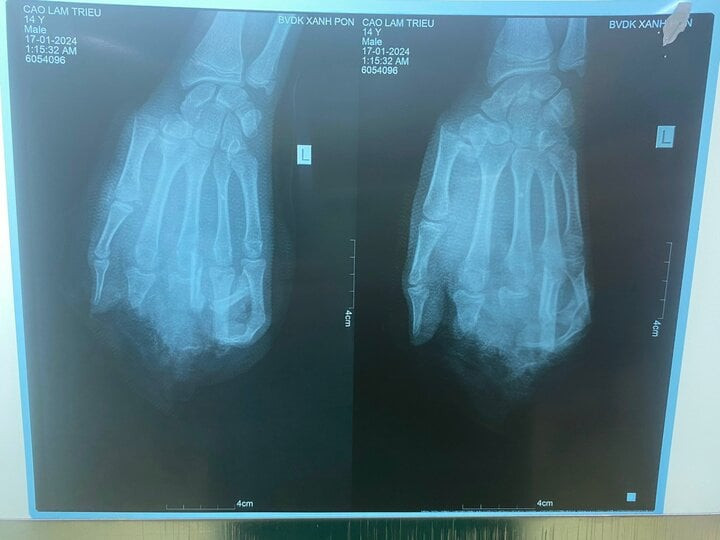Ảnh chụp X-quang bàn tay dập nát của bệnh nhân. Ảnh: BVCC Ảnh chụp X-quang bàn tay dập nát của bệnh nhân. Ảnh: BVCC