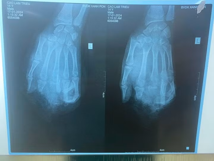 Ảnh chụp X-quang bàn tay dập nát của bệnh nhân. Ảnh: BVCC