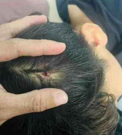 Hình ảnh học sinh bị chảy máu đầu mà phụ huynh đăng lên mạng xã hội. Ảnh chụp màn hình Hình ảnh học sinh bị chảy máu đầu mà phụ huynh đăng lên mạng xã hội. Ảnh chụp màn hình
