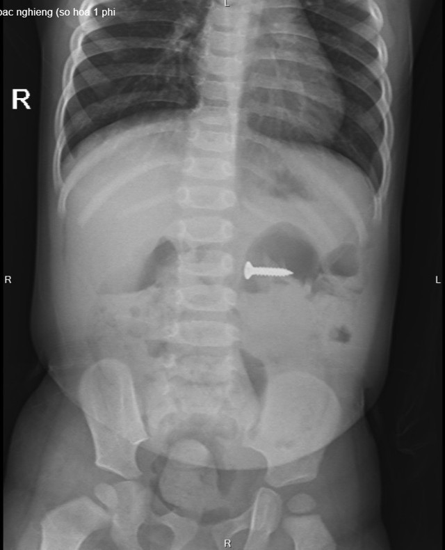 Chiếc đinh vít sắc nhọn nằm trong dạ dày bệnh nhi trên phim chụp X-quang Chiếc đinh vít sắc nhọn nằm trong dạ dày bệnh nhi trên phim chụp X-quang