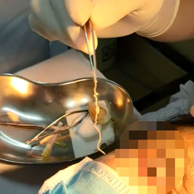 Con giun dài 10cm được bác sĩ gắp ra khỏi mắt của người bệnh Con giun dài 10cm được bác sĩ gắp ra khỏi mắt của người bệnh