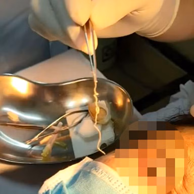 Con giun dài 10cm được bác sĩ gắp ra khỏi mắt của người bệnh