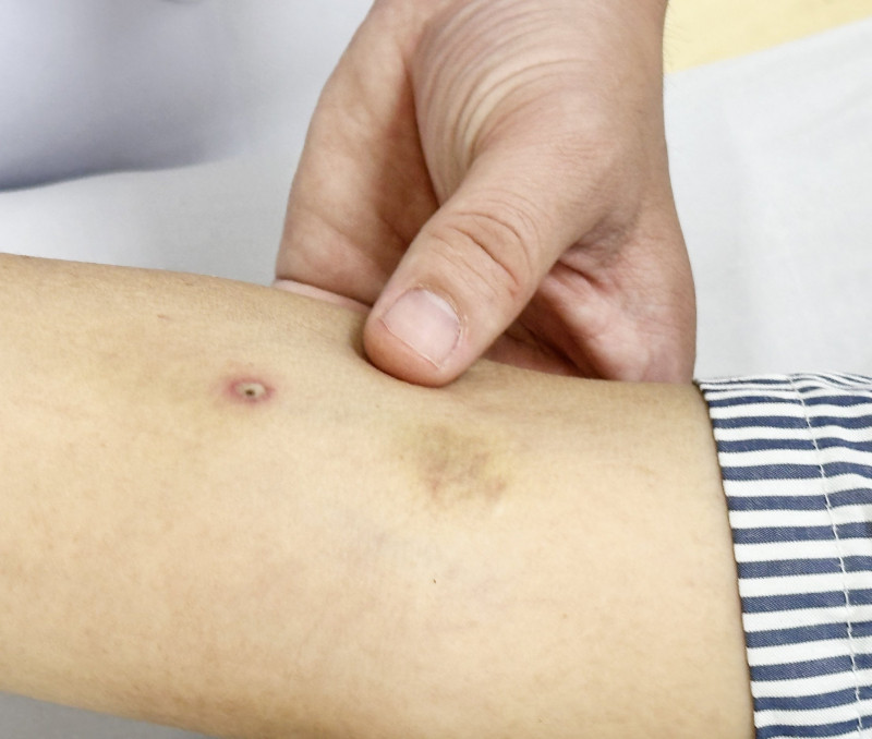 Vết ong đốt trên tay bệnh nhân C đã bớt đau Vết ong đốt trên tay bệnh nhân C đã bớt đau