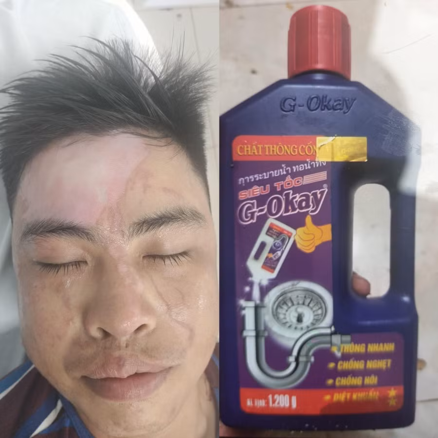 Anh Thái bị bỏng rộng vùng mặt do sử dụng chai thông cống siêu tốc. Ảnh: Kim Hằng