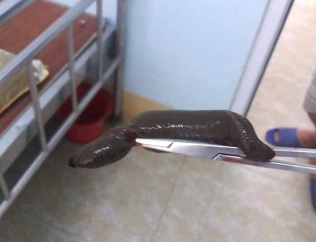 Con đỉa dài 15 cm được gắp ra khỏi cơ thể ông T.