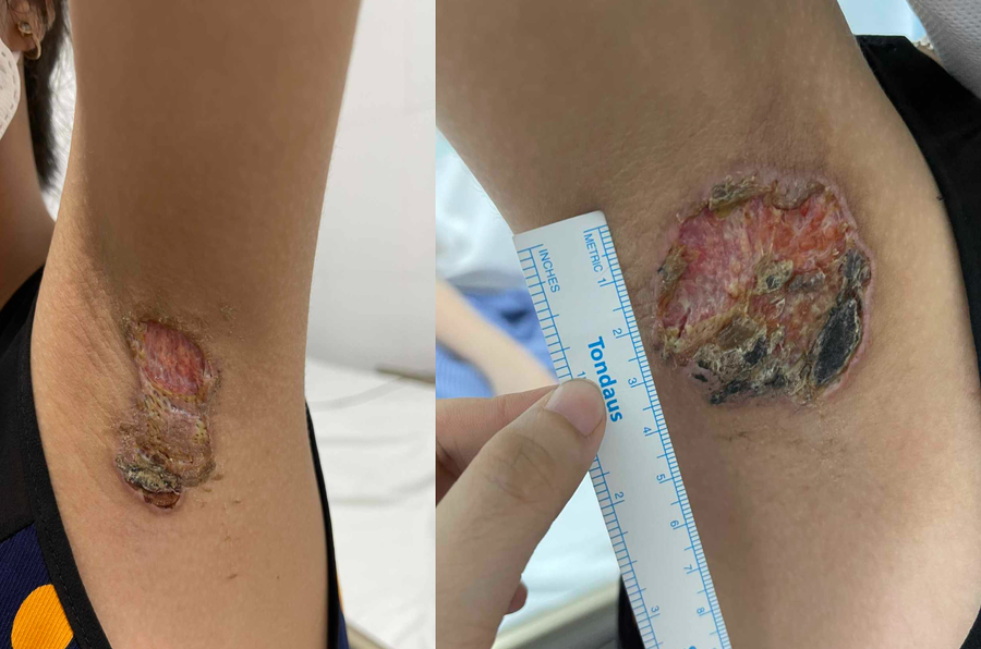 Hai vết bỏng, hoại tử lớn ở hai nách bé gái. Theo bác sĩ Quân dù có điều trị hết viêm nhưng vẫn có nguy cơ để lại sẹo lớn, gây co kéo nách. Ảnh: Bác sĩ cung cấp