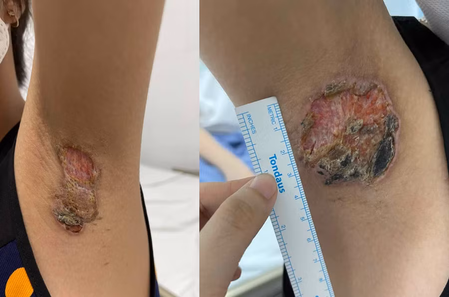 Hai vết bỏng, hoại tử lớn ở hai nách bé gái. Theo bác sĩ Quân dù có điều trị hết viêm nhưng vẫn có nguy cơ để lại sẹo lớn, gây co kéo nách. Ảnh: Bác sĩ cung cấp Hai vết bỏng, hoại tử lớn ở hai nách bé gái. Theo bác sĩ Quân dù có điều trị hết viêm nhưng vẫn có nguy cơ để lại sẹo lớn, gây co kéo nách. Ảnh: Bác sĩ cung cấp