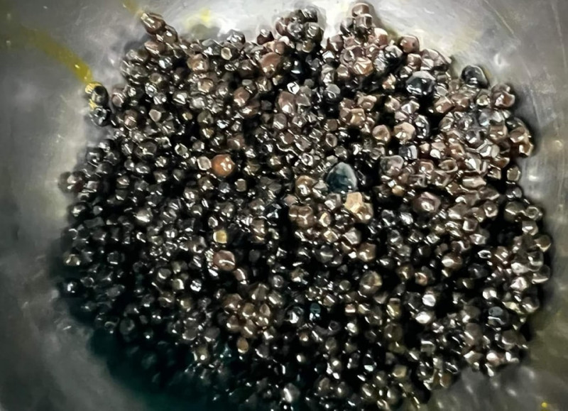 Hàng ngàn viên sỏi lấy ra từ trong túi mật của người phụ nữ 73 tuổi Hàng ngàn viên sỏi lấy ra từ trong túi mật của người phụ nữ 73 tuổi