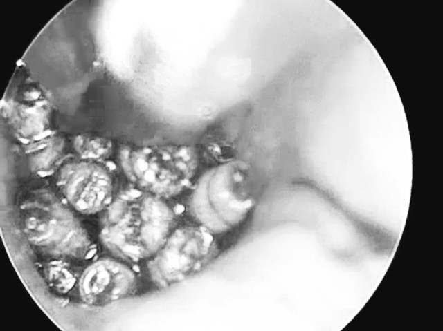 Giòi sống trong tai bệnh nhân. Ảnh: Bệnh viện Đa khoa tỉnh Quảng Trị Giòi sống trong tai bệnh nhân. Ảnh: Bệnh viện Đa khoa tỉnh Quảng Trị