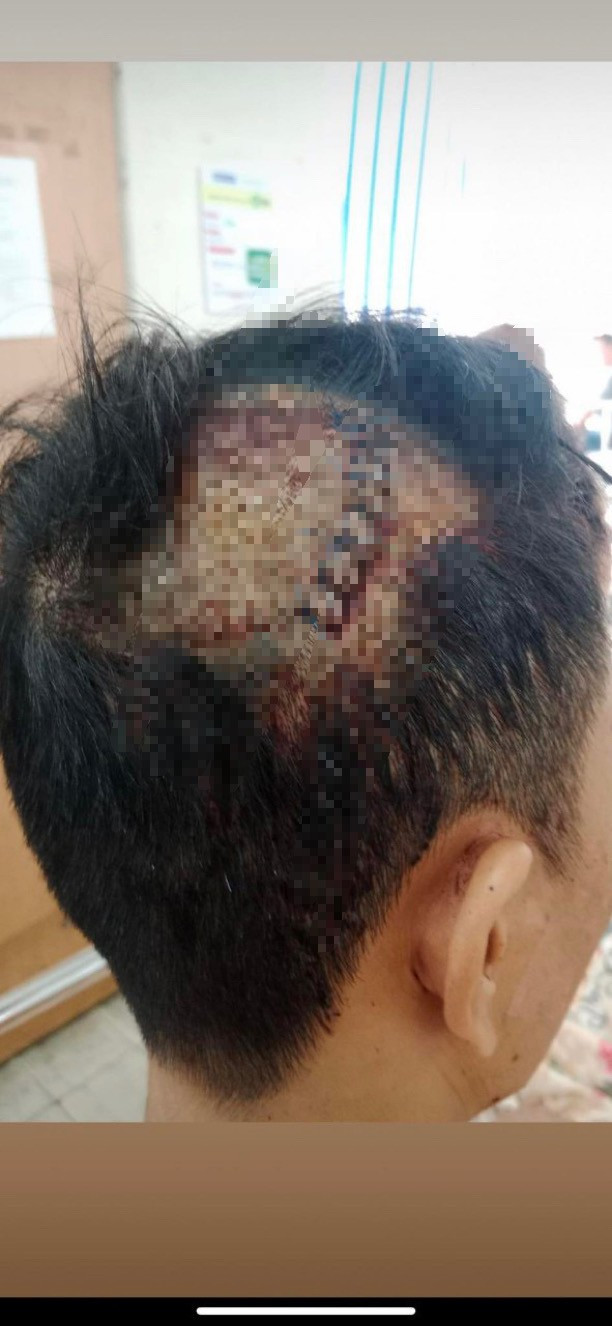 Phần đầu may nhiều mũi của nạn nhân. (Ảnh: Người nhà cung cấp)