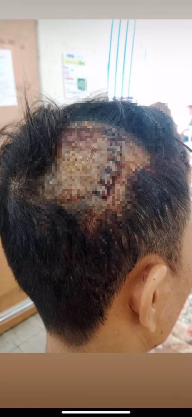 Phần đầu may nhiều mũi của nạn nhân. (Ảnh: Người nhà cung cấp)