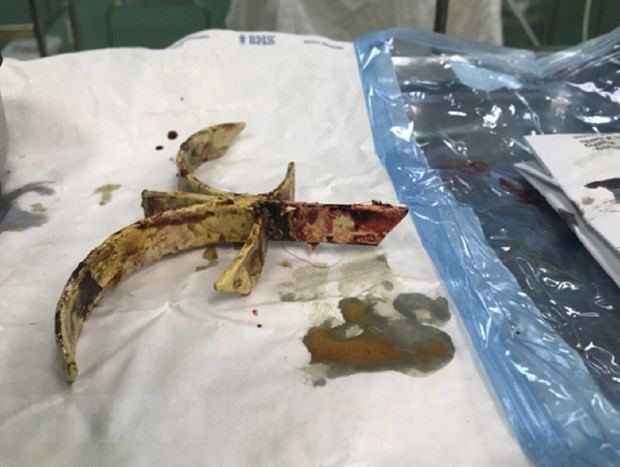 Dị vật là một phần của hoa văn cửa sắt hàng rào sau khi rút ra từ hộp sọ của nạn nhân. (Ảnh: TTXVN)