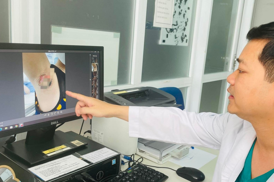 Bác sĩ Quân chia sẻ về ca bệnh tai biến sau khi đốt điện chữa hôi nách ở spa. Ảnh: D.Ngọc