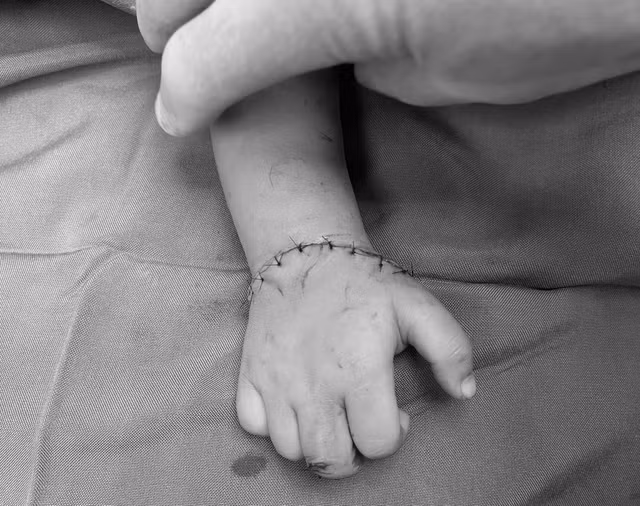 Bàn tay bị đứt lìa của bệnh nhi đã được nối thành công. Ảnh: Bệnh viện cung cấp