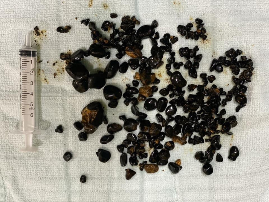 Số sỏi kích thước lớn, màu nâu sậm sau khi được lấy ra từ bệnh nhân N.