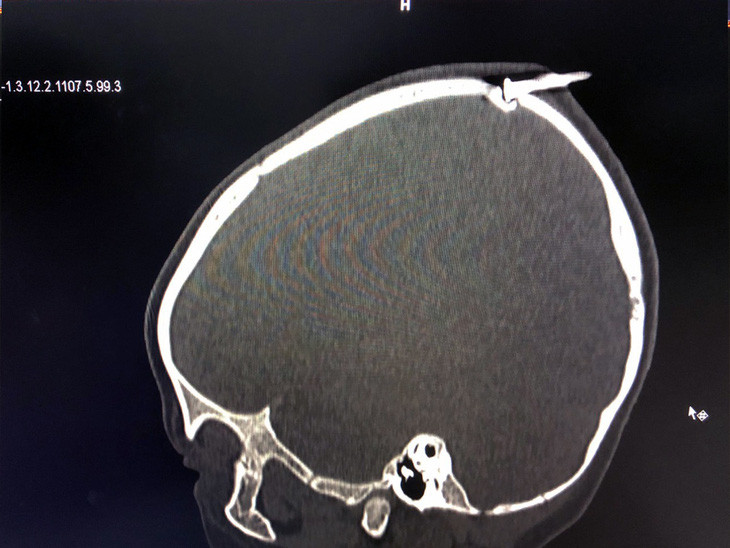 Cây đinh sắt đâm vào đỉnh đầu bé trai 2 tuổi làm lún xương sọ. Ảnh: Bệnh viện cung cấp